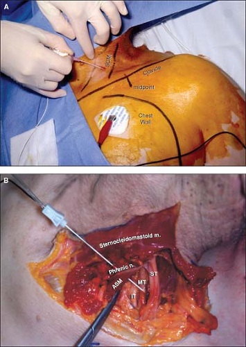 Continuous Brachial Plexus Nerve Block Anesthesia Key