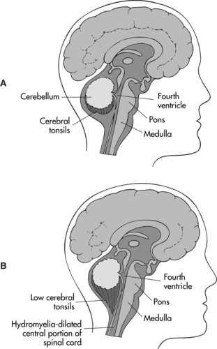 Arnold Chiari Malformation Anesthesia Key