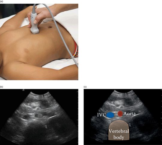 Inferior Vena Cava Aorta Assessment Anesthesia Key