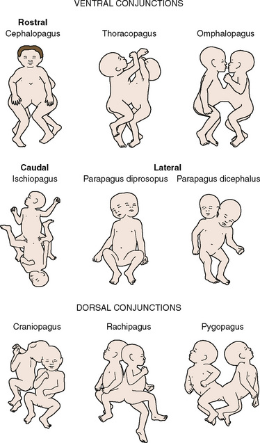 Anesthesia for Conjoined Twins | Anesthesia Key