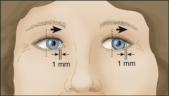 Vertigo (Dizziness, Lightheadedness) | Anesthesia Key