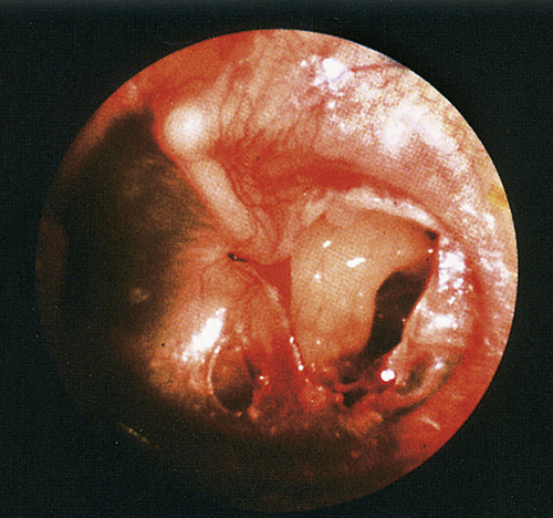 Perforated Tympanic Membrane (Ruptured Eardrum) | Anesthesia Key