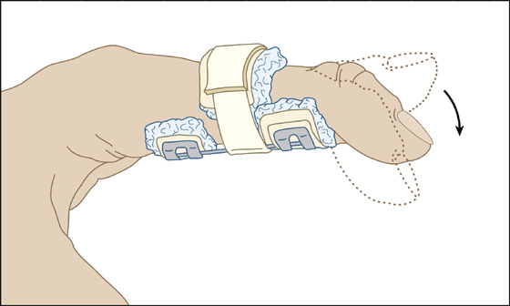 Boutonnière Finger | Anesthesia Key