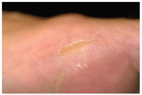 Management of Corns and Calluses | Anesthesia Key