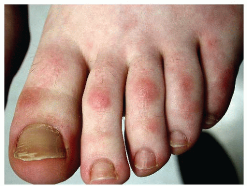 Management of Corns and Calluses | Anesthesia Key