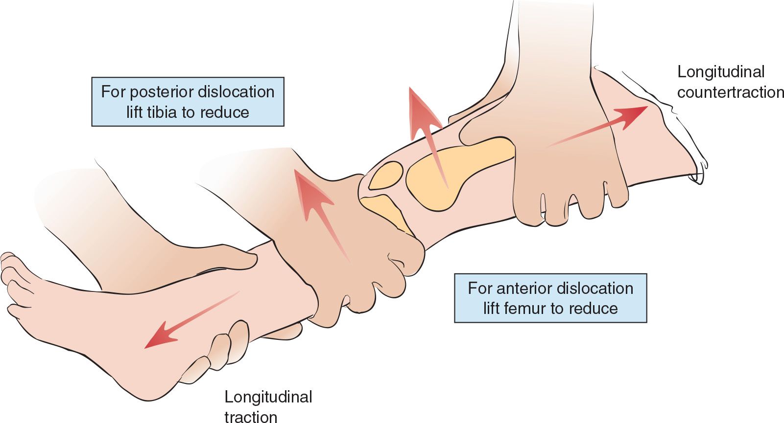 Knee Dislocation And Reduction Anesthesia Key 3683