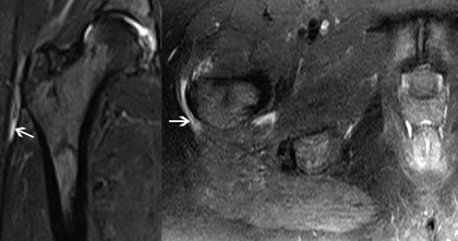 Imaging for Evaluation of Groin Pain | Anesthesia Key