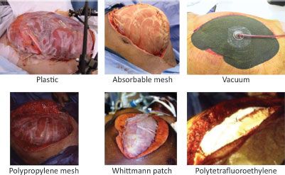 Abdominal Wall Hernias: Emergencies and Reconstruction | Anesthesia Key