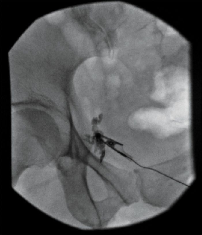 Pudendal Nerve Block | Anesthesia Key