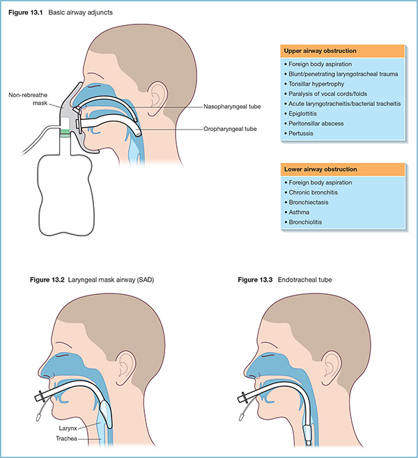 Diagram shows basic airway adjuncts with markings for non-breathe mask, nasopharyngeal tube and oropharyngeal tube, and tables for upper and lower airway obstruction.