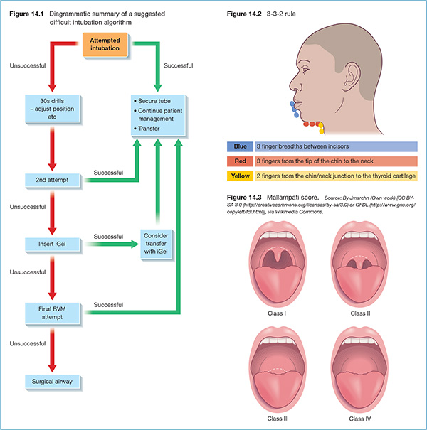 Chart shows algorithm of suggested difficult intubation with markings for attempted intubation, secure tube, 30s drills - adjust position, insert iGel, final BVM attempt, et cetera.