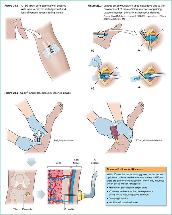 Diagram shows 16G large-bore cannula which is well-secured with tape for transit to prevent dislodgement and loss of venous.