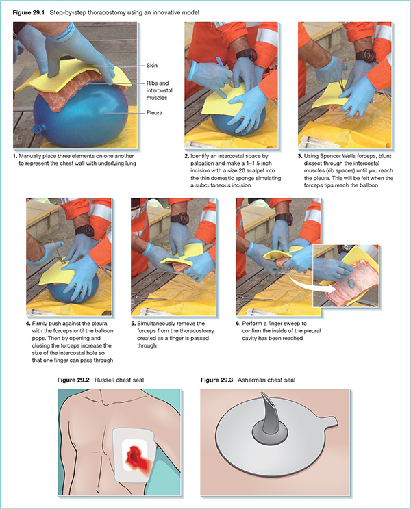 Photographs show usage of innovative model for step-by-step thoracostomy with markings for skin, ribs and intercostal muscles and pleura.