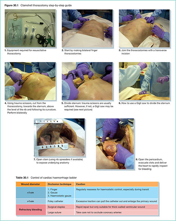 Photographs show step-by-step guide of clamshell thoracotomy with markings for start by making bilateral finger thoracostomies, how to use Gigli saw to divide sternum, et cetera. Diagram shows e-Fast scan and its scanned areas with markings for anterior right lung, anterior left lung, pericardial view, perisplenic view, perihepatic view and pelvic view (bladder).