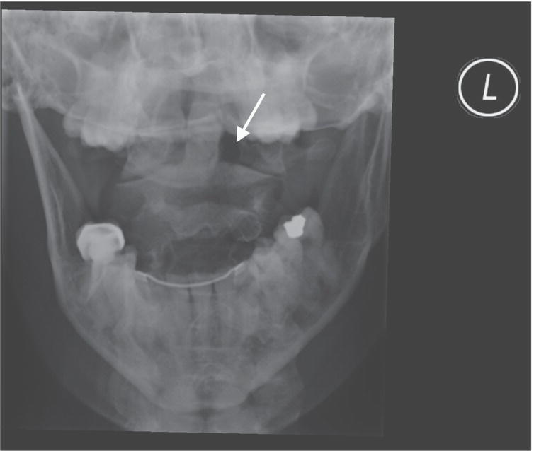 Schematic illustration of open mouth odontoid cervical spine X-ray showing widening of the lateral pillar (arrow) of the first cervical vertebra, consistent with acute fracture.