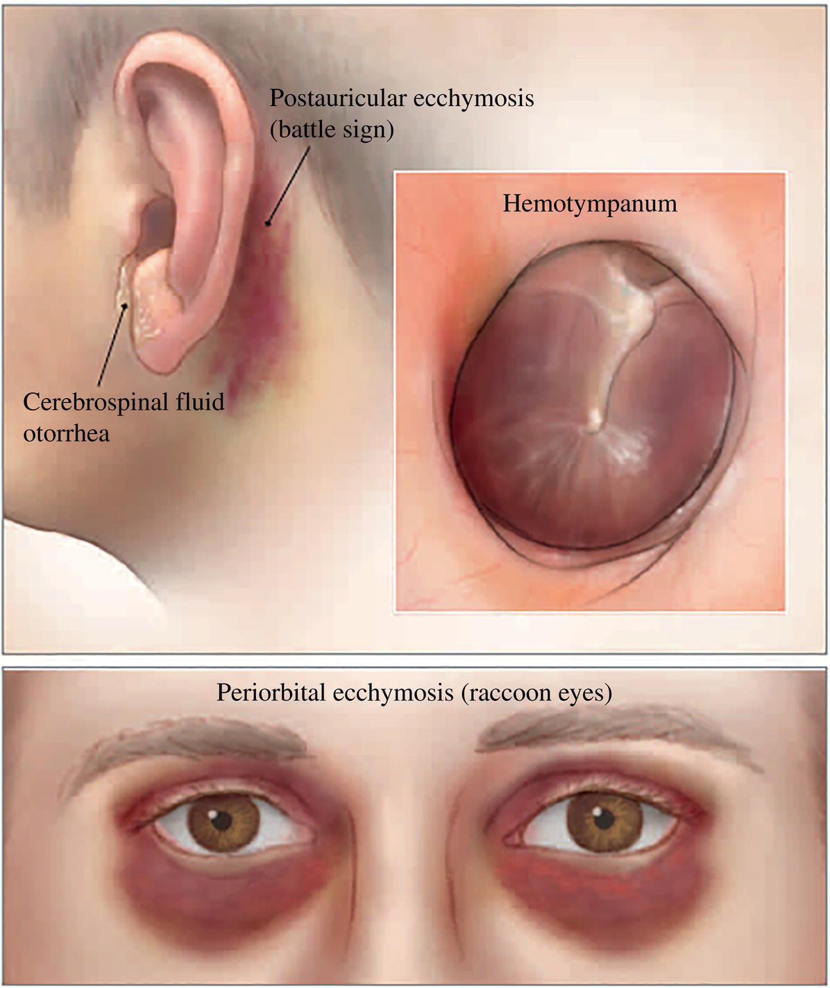 Schematic illustration of findings suggestive of basilar skull fractures are Battle sign, hemotympanum, cerebrospinal fluid otorrhea, or raccoon eyes.