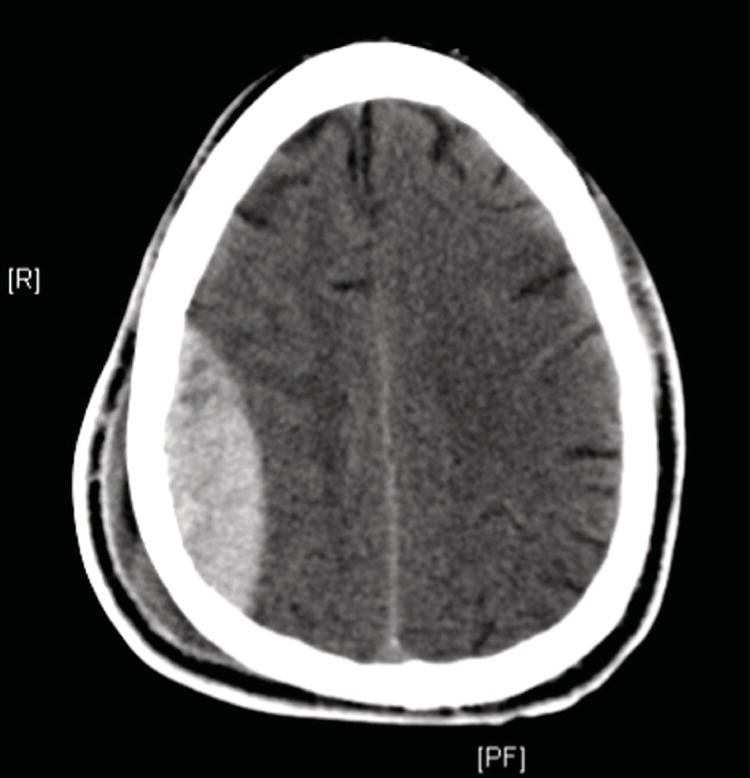 Schematic illustration of acute epidural hematoma.