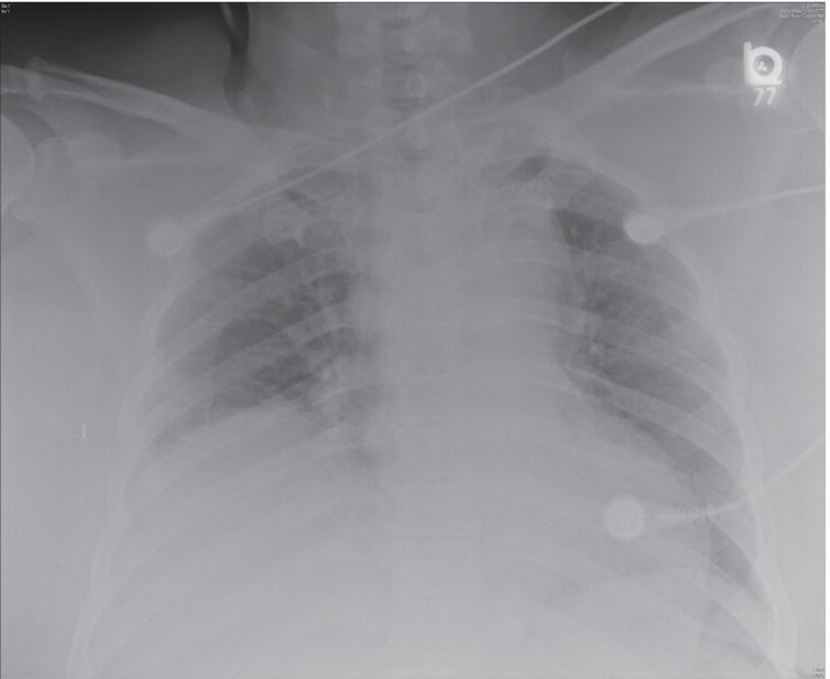 Schematic illustration of chest X-ray from a patient with a traumatic aortic injury demonstrating a wide mediastinum, blurring of the aortic arch, left apical cap, and deviation of the nasogastric tube.