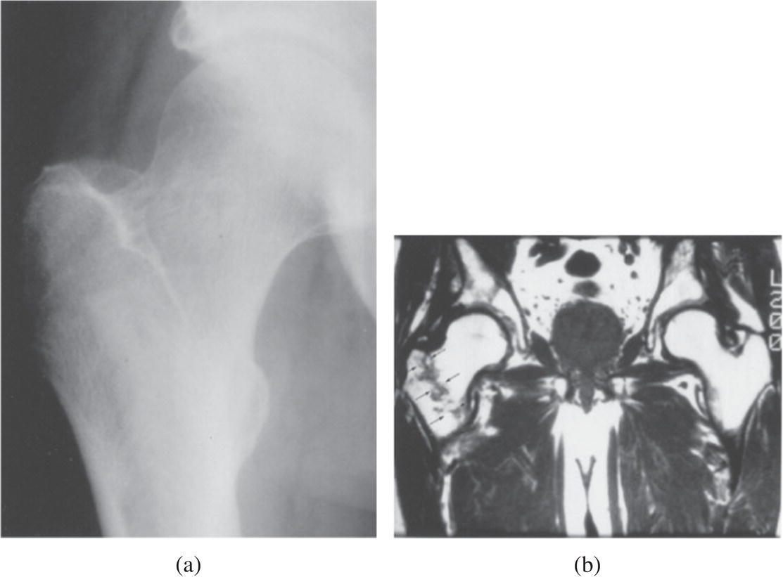 Schematic illustration of occult hip fracture.