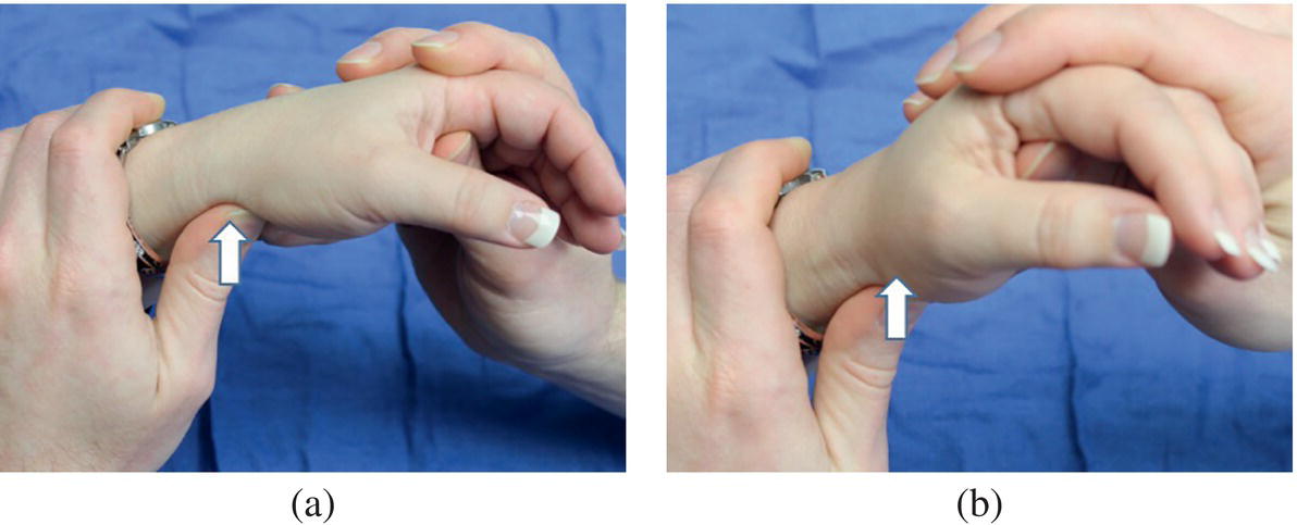 Photo depicts scaphoid shift (Watson's test).