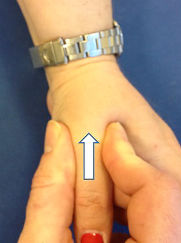 Photo depicts starting in ulnar deviation, the examiner puts pressure under the distal scaphoid pushing dorsally as the wrist is radially deviated.