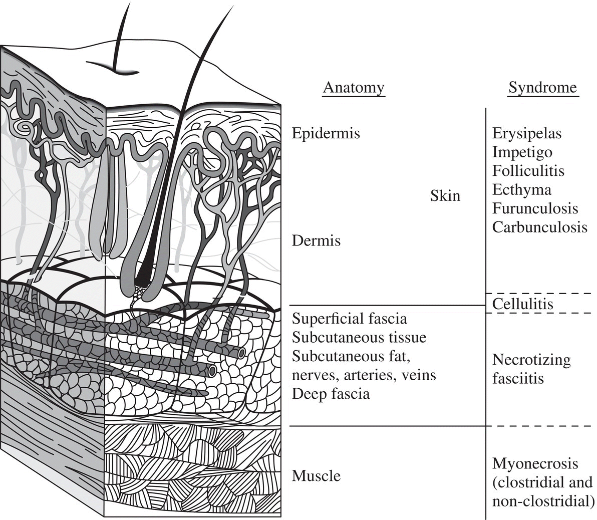 Schematic illustration of the different layers of the skin and the corresponding infections associated with each layer.