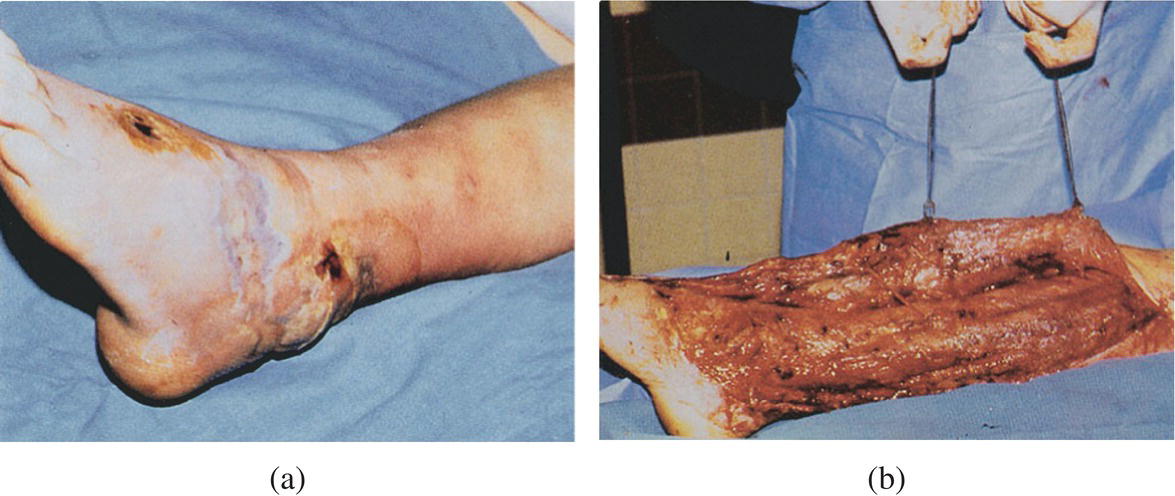 Photos of (a) a suspected case of necrotizing fasciitis. (b) Surgical exploration resulted in extensive debridement.