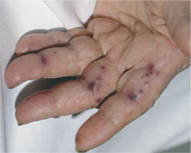 Photo of janeway's lesions from bacterial endocarditis.