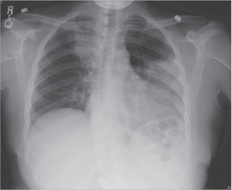 Photo of left lower lobe pneumonia.