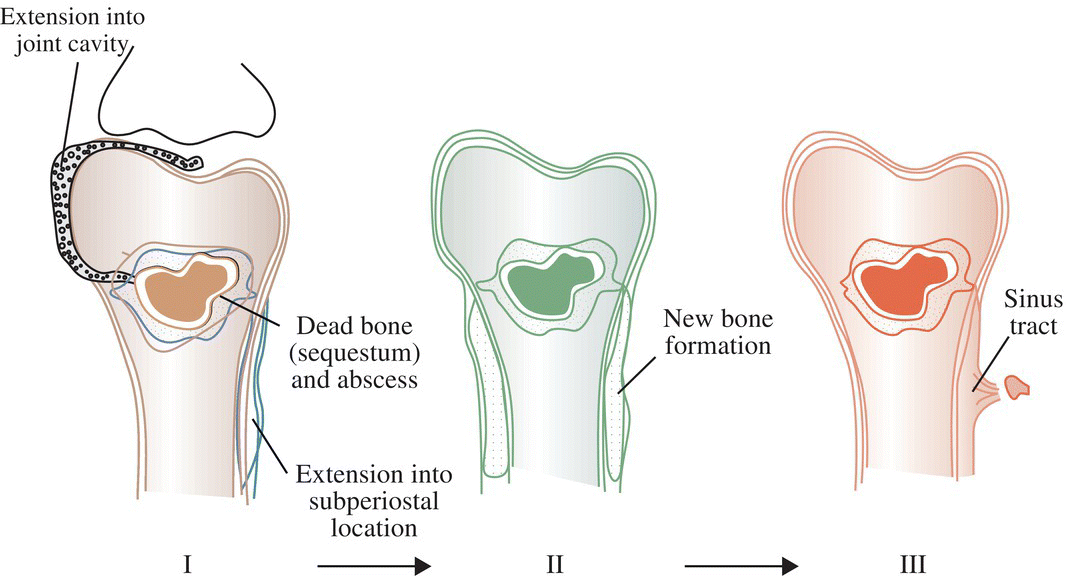 Schematic illustration of the progression of chronic osteomyelitis.