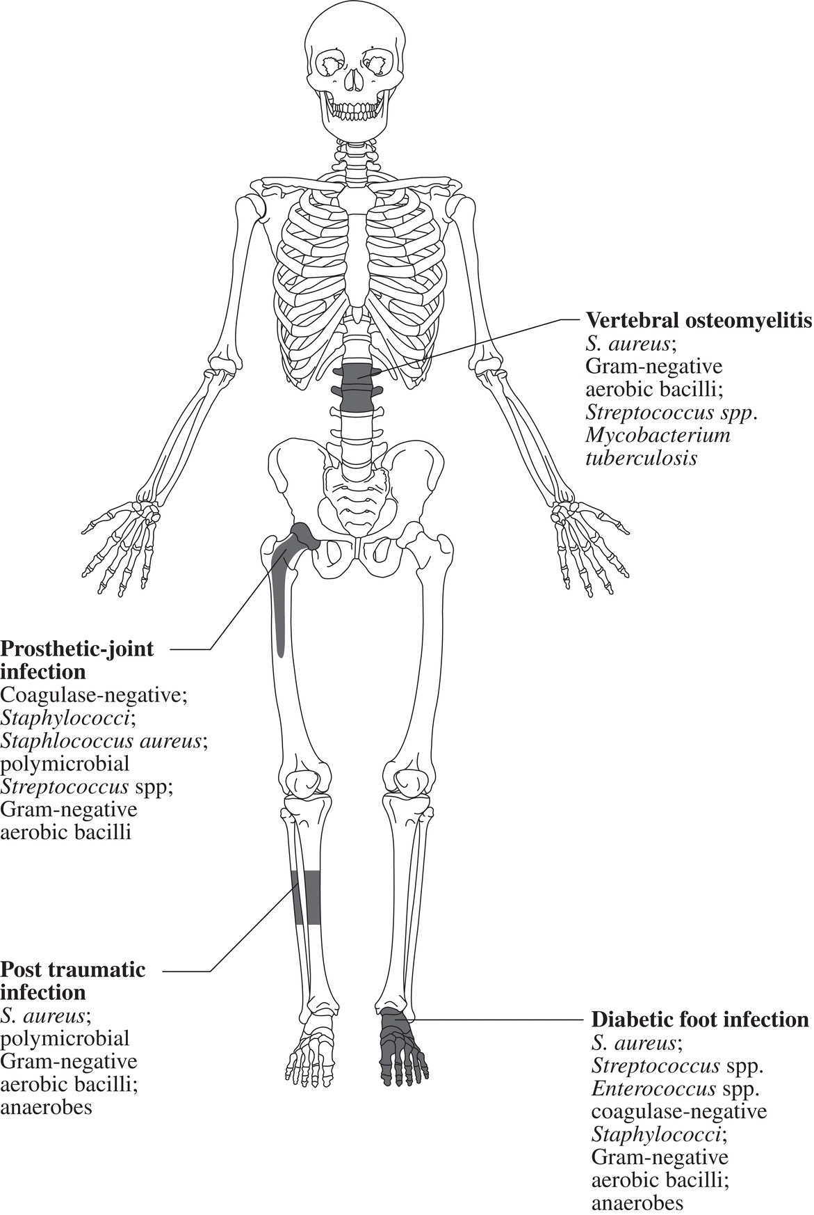 Schematic illustration of the microbiology of osteomyelitis.