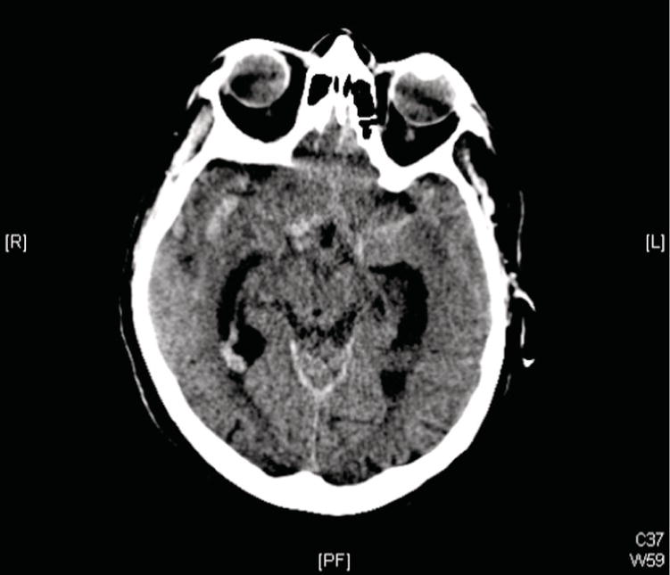 Schematic illustration of noncontrast head computed tomography (CT) showing an acute subarachnoid hemorrhage.