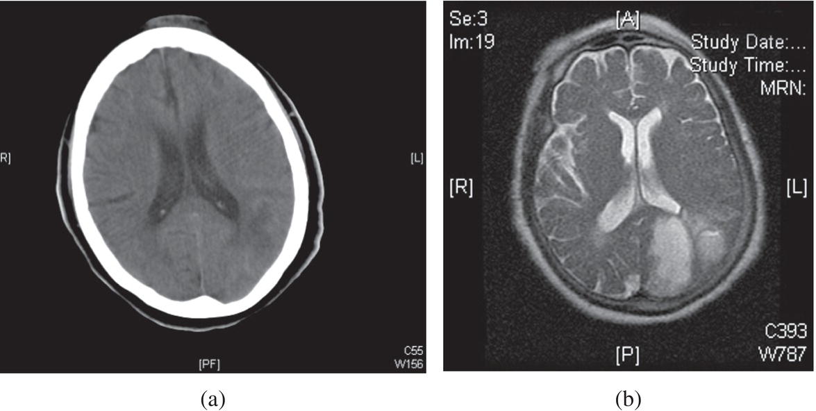 Schematic illustration of noncontrast head CT showing ischemic stroke in the left posterior cerebral artery region (a), confirmed on MRI (b).