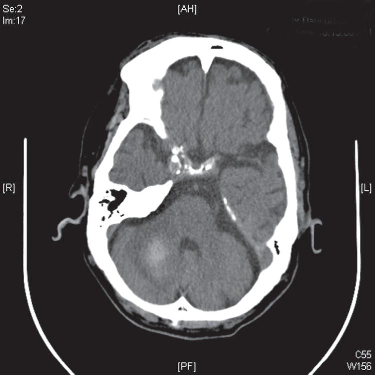 Schematic illustration of noncontrast head CT showing a right cerebellar hemorrhage.