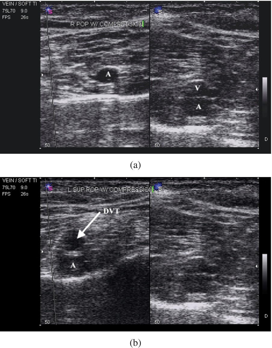 Schematic illustration of compression ultrasound of the right and left popliteal vessels.