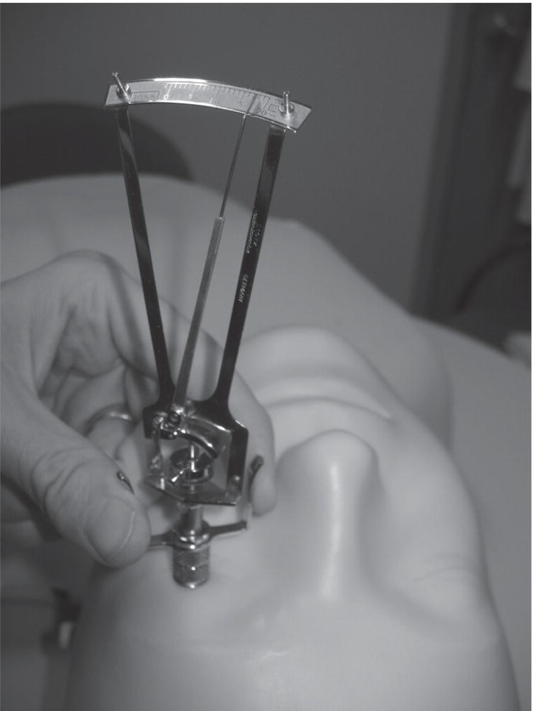 Photo depicts use of the Schiotz tonometer on a supine patient.