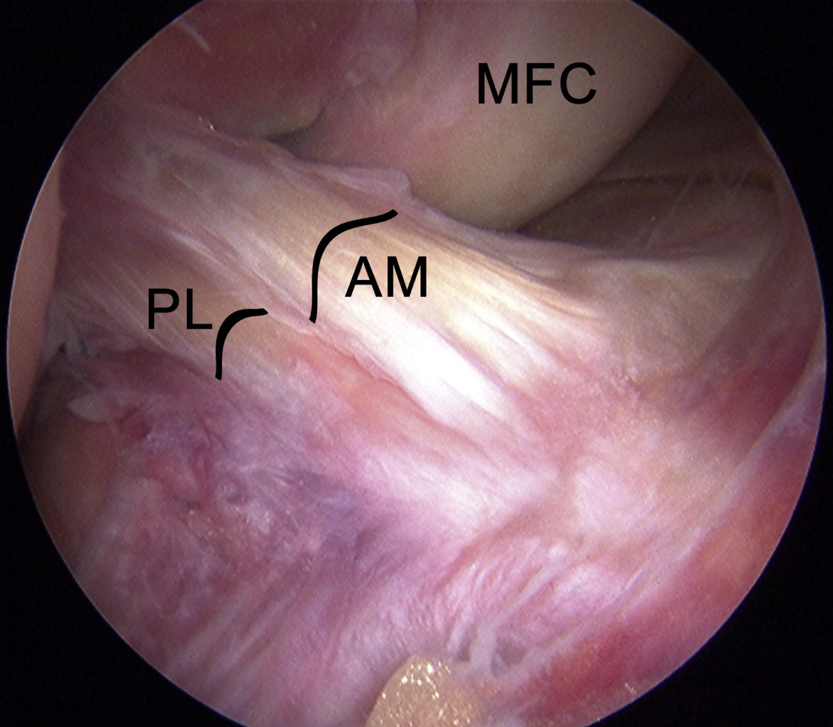The Arthroscopic view of right knee at 110° flexion showing anteromedial (AM) and posterolateral (PL) ligament bundles with medial femoral condyle (MFC) visible for orientation. The Arthroscopic view of the right knee at 110 degrees flexion showing two distinct ligament bundles: the anteromedial (AM) bundle and the posterolateral (PL) bundle, both clearly visualized. The medial femoral condyle (MFC) is seen adjacent to these bundles, providing anatomical orientation within the joint.