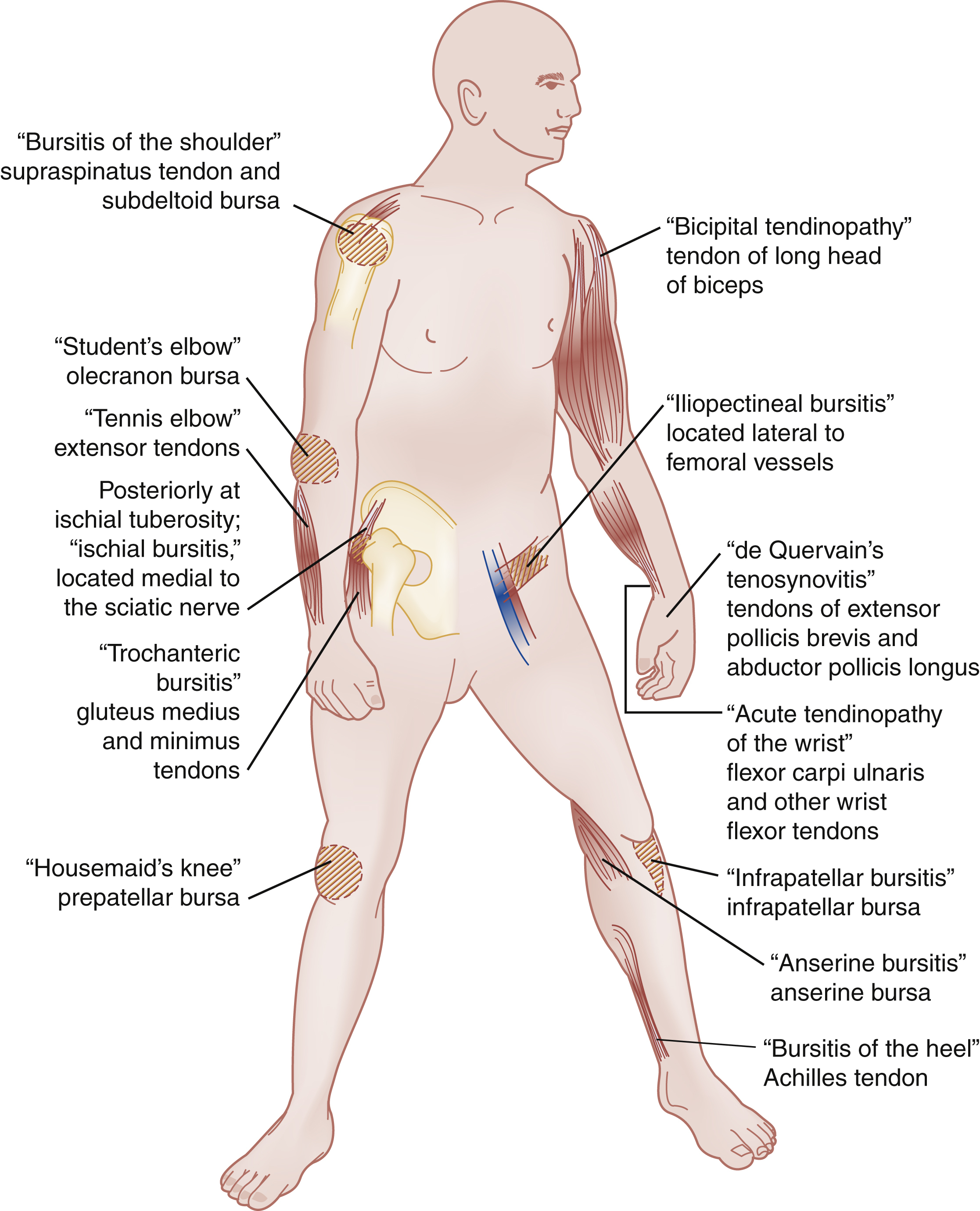 The diagram shows common tendinopathy or bursitis sites: shoulder, student’s elbow, tennis elbow, ischial, trochanteric, housemaid’s knee, bicipital, iliopsoas, wrist, infrapatellar, anserine, heel. The diagram shows a human figure common sites for tendinopathy or bursitis. On the left side, labeled areas include bursitis of the shoulder involving supraspinatus tendon and subdeltoid bursa, student’s elbow involving the olecranon bursa, tennis elbow involving the extensor tendons, posteriorly at ischial tuberosity ischial bursitis located medial to the sciatic nerve, trochanteric bursitis involving gluteus medius and minimus tendons, and housemaid’s knee involving the prepatellar bursa. On the right side, labeled areas include bicipital tendinopathy involving tendon of the long head of biceps, iliopsoas bursitis located lateral to femoral vessels, de Quervain’s tenosynovitis involving tendons of extensor pollicis brevis and abductor pollicis longus, acute tendinopathy of the wrist involving flexor carpi ulnaris and other wrist flexor tendons, infrapatellar bursitis involving the infrapatellar bursa, anserine bursitis involving the anserine bursa, and bursitis of the heel involving the Achilles tendon.