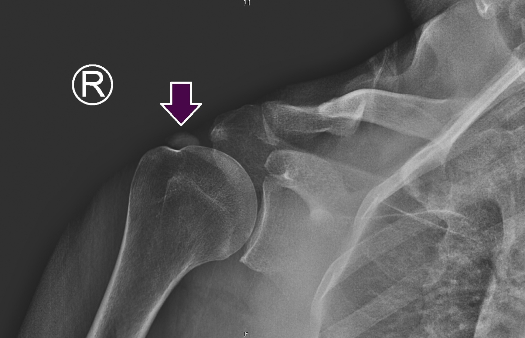 The X-ray shows the right shoulder calcium deposit in the supraspinatus tendon, marked by an arrow, shows calcific tendinopathy causing pain and limited motion. The X ray shows the right shoulder with a prominent calcium deposit in the supraspinatus tendon shows by a downward arrow. The calcium deposit is associated with acute pain and decreased range of motion, consistent with calcific tendinopathy. The humeral head, clavicle, and scapula are visible in the radiograph, showing the location of the deposit within the shoulder joint region.