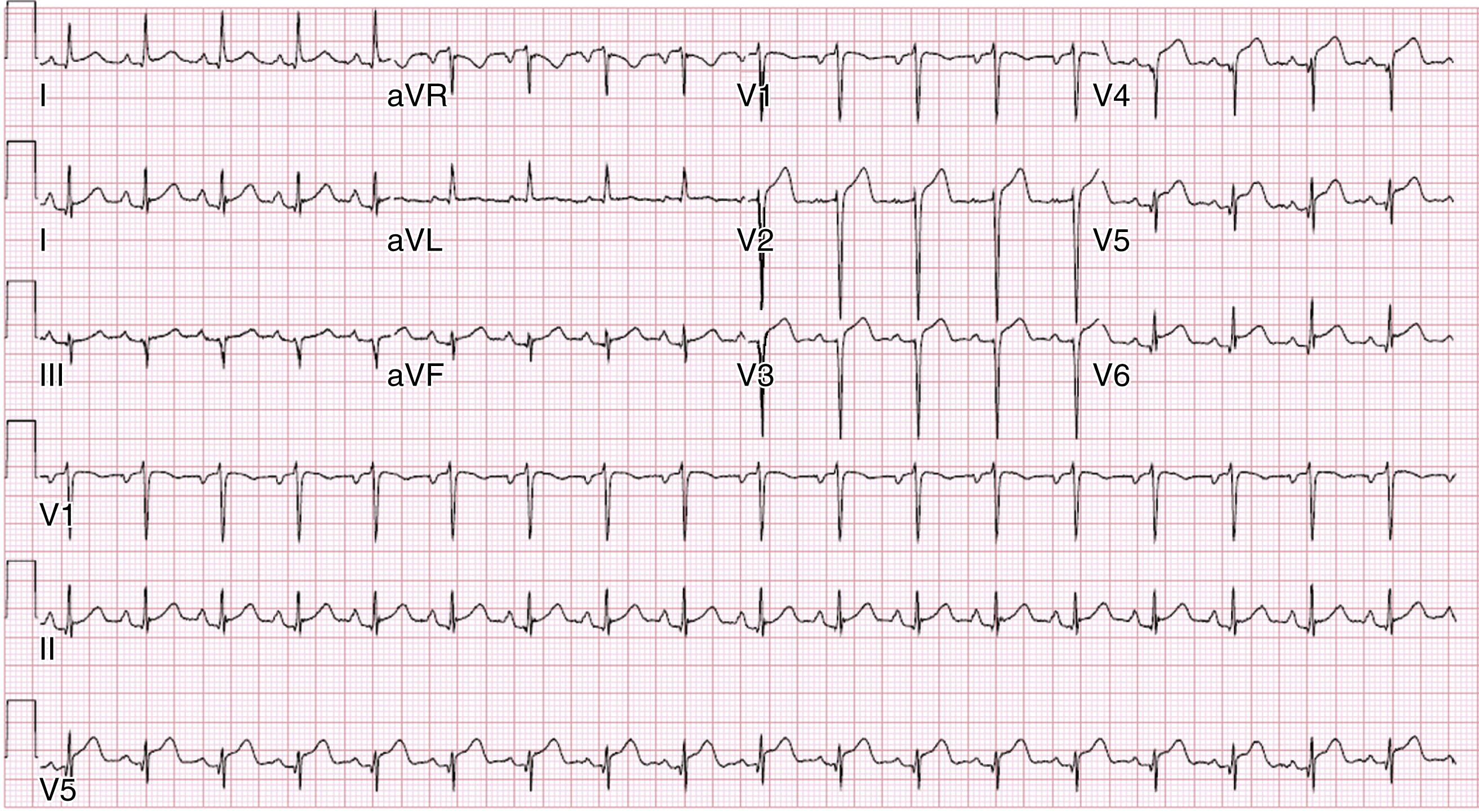 The ECG shows diffuse ST elevation, no reciprocal changes, PR depression (esp. lead II), anterior Q waves (old MI). 38F with SLE, seizures, chest pain in ED. The ECG shows a 12-lead with leads I, II, III, aVR, aVL, aVF, V1, V2, V3, V4, V5, and V6. It demonstrates diffuse ST elevation without reciprocal changes and PR depression, most evident in lead II. Q waves are visible in anterior leads, shows a prior myocardial infarct. The ECG belongs to a 38-year-old woman with systemic lupus erythematosus who presented to the emergency department with seizures and developed chest pain while in the ED.