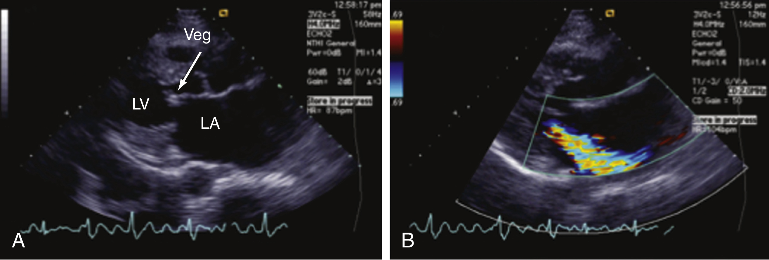 A set of two ECG shows, Panel A shows LV, LA, and Veg on the mitral valve; Panel B color Doppler shows mitral regurgitation jet into LA during systole. ECG trace below. A set of two ECG shows, Panel A is a parasternal long-axis view of the heart with labeled structures including LV (left ventricle), LA (left atrium), and a vegetation marked as Veg on the mitral valve. Panel B is the same view with color Doppler demonstrating mitral regurgitation, seen as a color jet flowing from the valve into the left atrium during systole.