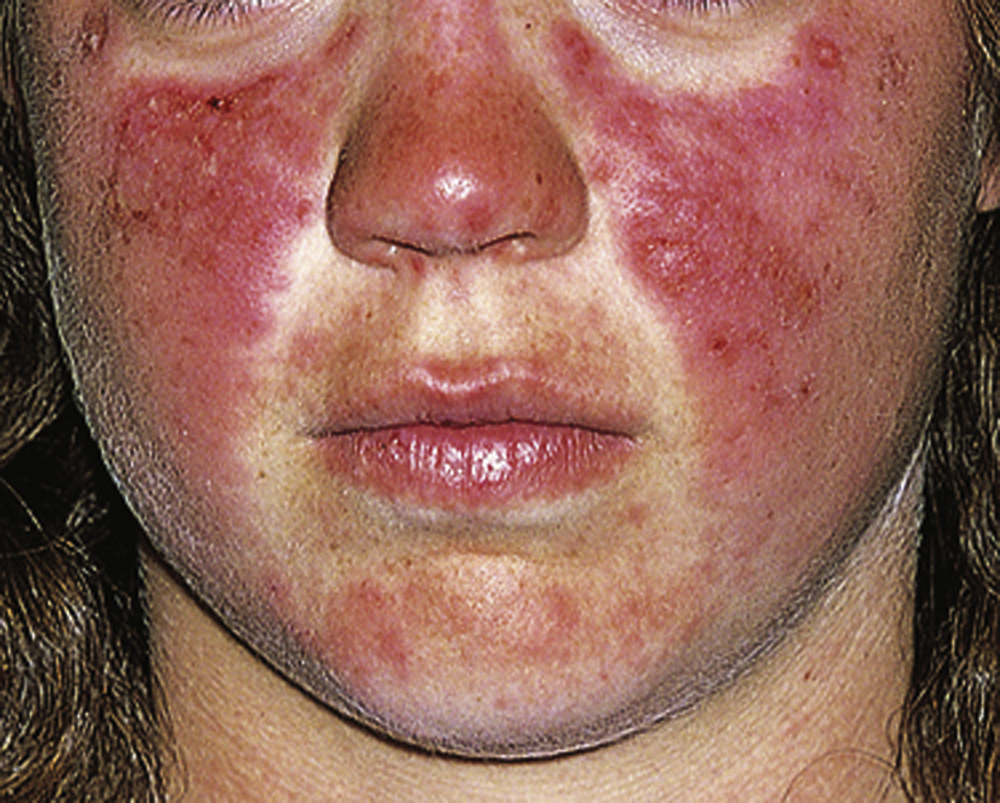 The photograph shows face with red rash across cheeks and bridge of nose, sparing nasolabial folds, forming a butterfly or malar pattern; lips, chin, and jawline mostly unaffected.