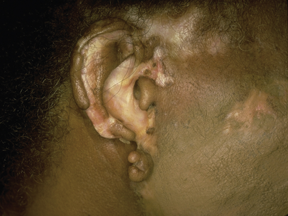 The photograph shows right ear tissue loss, scarring, and irregular contour with pigment changes including hypo- and hyperpigmentation, shows chronic destructive changes.