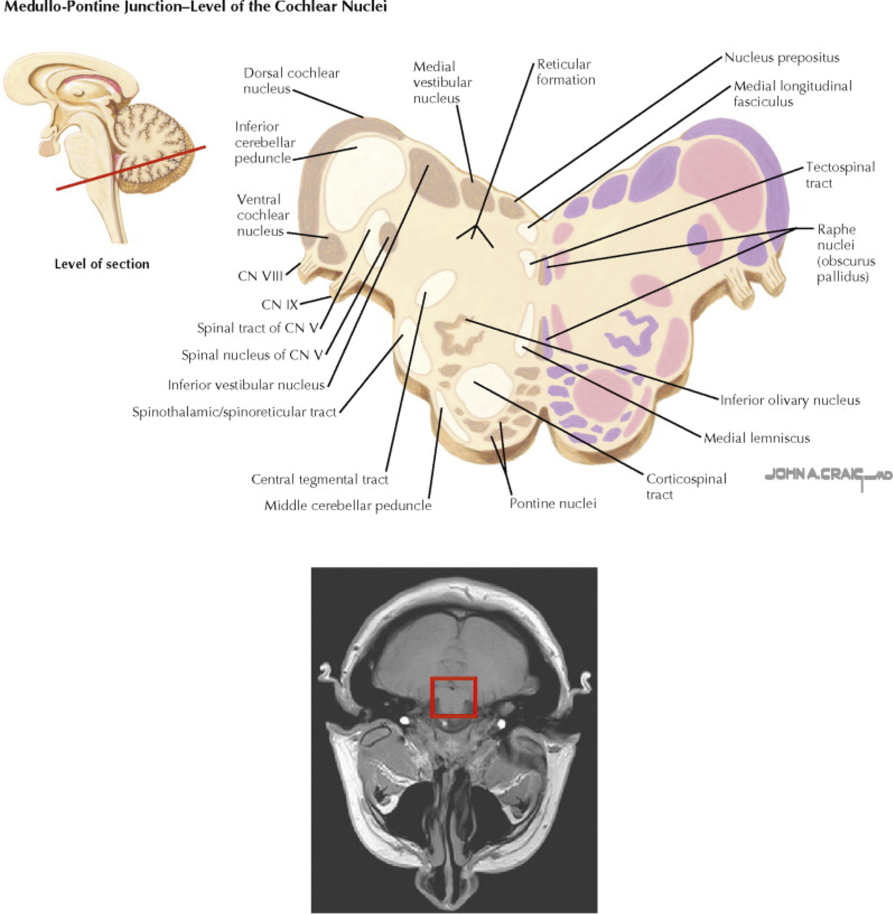 The diagram shows medullo-pontine junction and MRI shows cochlear nuclei, brainstem tracts, cranial nerves, and structures vital for arousal via the ascending reticular activating system. The diagram shows the medullo-pontine junction at the level of the cochlear nuclei and corresponding MRI. The dorsal cochlear nucleus, ventral cochlear nucleus, medial vestibular nucleus, inferior vestibular nucleus, spinal nucleus of cranial nerve V, spinothalamic/spinoreticular tract, central tegmental tract, middle cerebellar peduncle, pontine nucleus, corticospinal tract, medial lemniscus, inferior olivary nucleus, CN VIII, CN VII, nucleus prepositus, medial longitudinal fasciculus, reticular formation, tectospinal tract, raphe nuclei, and locus coeruleus. A smaller sagittal brain view marking the level of the section and a bottom MRI scan with a red box shows the relevant region of interest. The diagram emphasizes structures associated with the ascending reticular activating system and surrounding brainstem pathways essential for arousal.