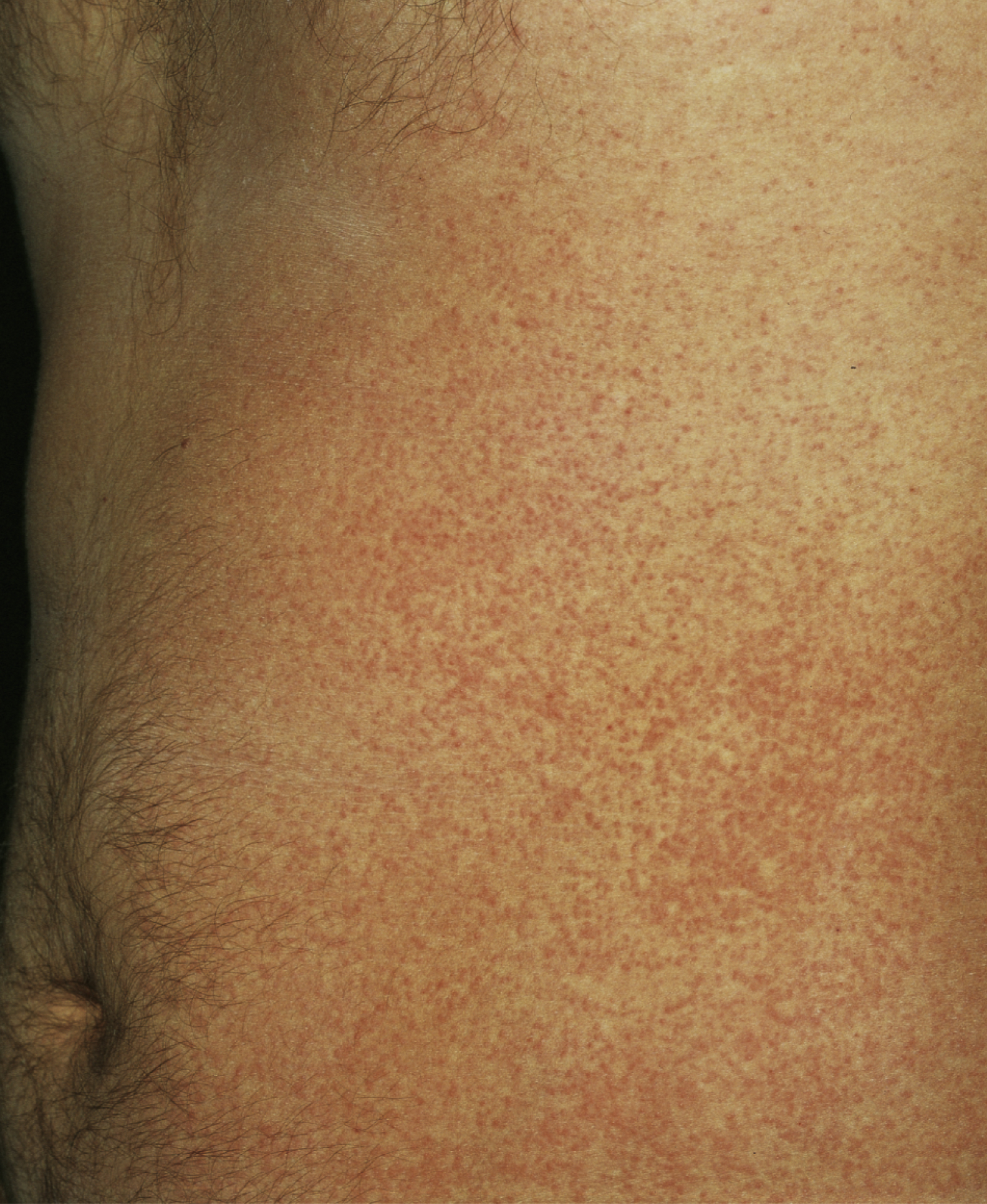 The photograph shows lower torso and abdomen have a widespread prickly heat rash with numerous small red papules forming a diffuse pattern, concentrated near the waistline and groin region.