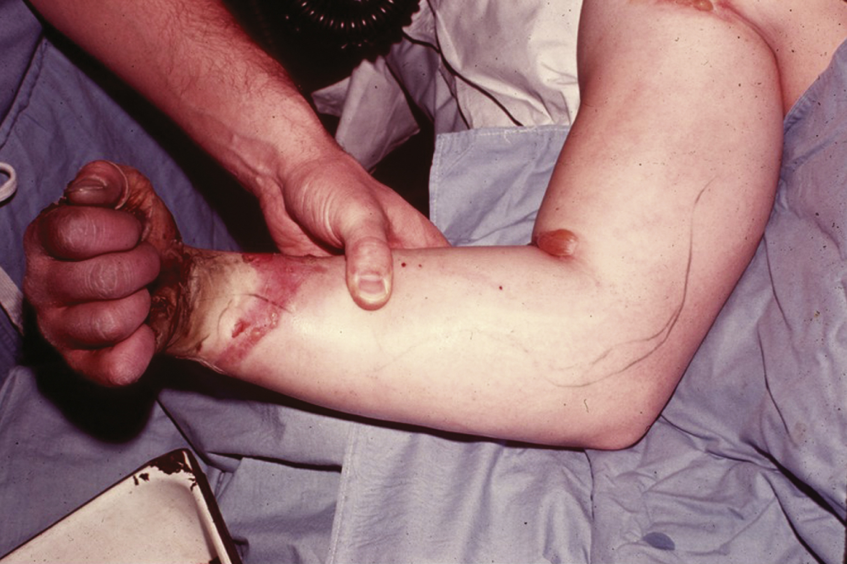 The photograph shows kissing burn on the arm has matching burn marks where the forearm and upper arm touched during an electrical incident, with the arm held for examination on blue medical drapes.