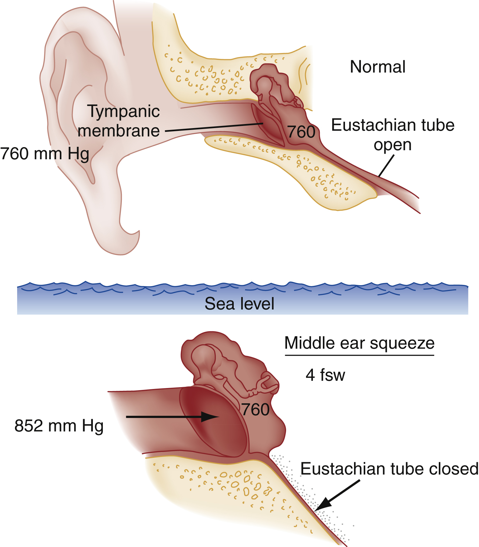 The diagram shows normal ear with open Eustachian tube and 760 mm Hg pressure; at 4 fsw, closed tube traps 760 mm Hg while outside is 852 mm Hg, pushing inward on tympanic membrane. The diagram shows two ear cross-sections. The top ear labeled “Normal” has an open “Eustachian tube” and a “Tympanic membrane” with equal pressure labeled “760 mm Hg.” The lower ear labeled “Middle ear squeeze” at “4 fsw” shows a closed “Eustachian tube,” internal pressure labeled “760,” and external water pressure labeled “852 mm Hg,” with an arrow pushing inward on the tympanic membrane, shows imbalance.
