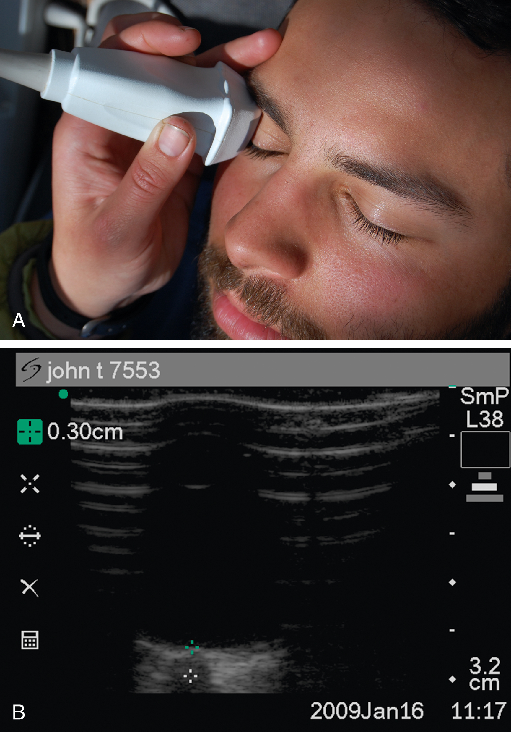 A set of two panels shows A and B. A, person supine with closed eyes has an ultrasound probe on eyelid. B, ultrasound screen shows optic nerve image with 0.30 cm measurement, depth 3.2 cm. A set of two panels shows A and B. Panel A shows a person lying supine with eyes closed while an ultrasound probe labeled L38 is placed on the closed eyelid at the lateral center of the pupil for optic nerve sheath ultrasonography. Panel B shows an ultrasound screen labeled john t 7553 displaying a cross-sectional optic nerve image with a measured diameter of 0.30 cm, depth marker 3.2 cm, date 2009Jan16, and time 11:17, along with ultrasound settings including SmP.