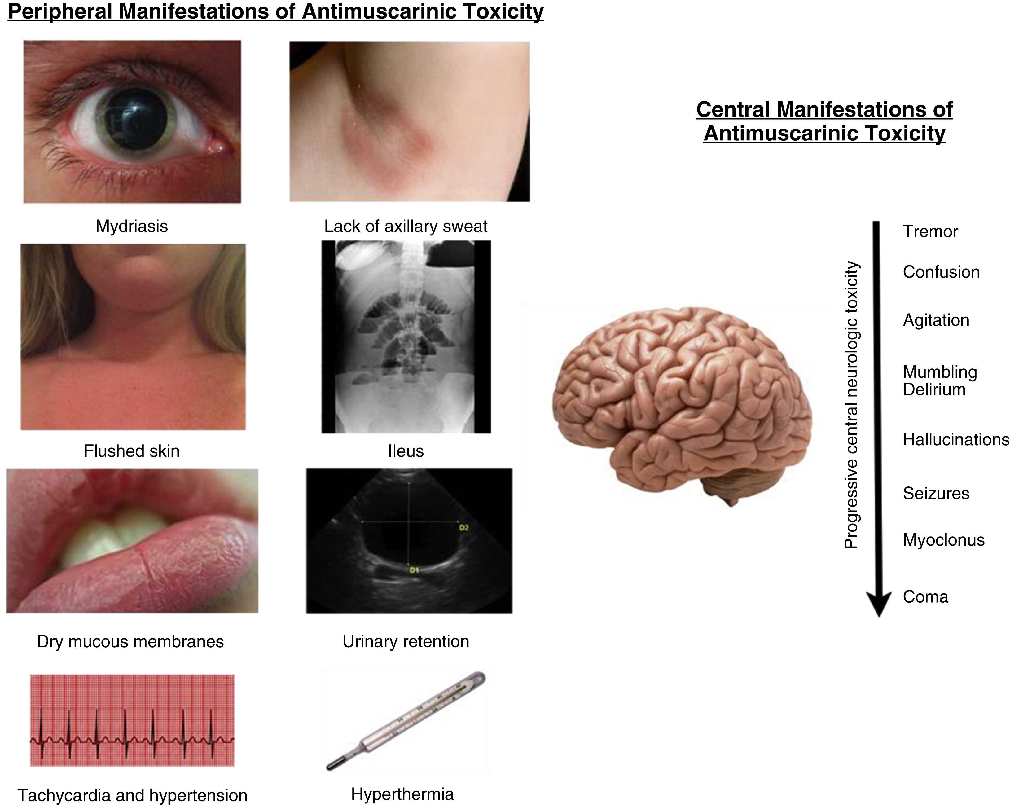 The educational medical infographic shows antimuscarinic toxicity: peripheral signs mydriasis, flushed skin, dry mucosa, tachycardia, urinary retention, hyperthermia; central signs tremor to coma. The educational medical infographic shows peripheral and central manifestations of antimuscarinic toxicity. Peripheral findings include mydriasis, lack of axillary sweat, flushed skin, ileus, dry mucous membranes, urinary retention, tachycardia and hypertension, and hyperthermia. Central manifestations show progressive neurologic toxicity depicted by a brain image with listed symptoms: tremor, confusion, agitation, mumbling delirium, hallucinations, seizures, myoclonus, and coma.