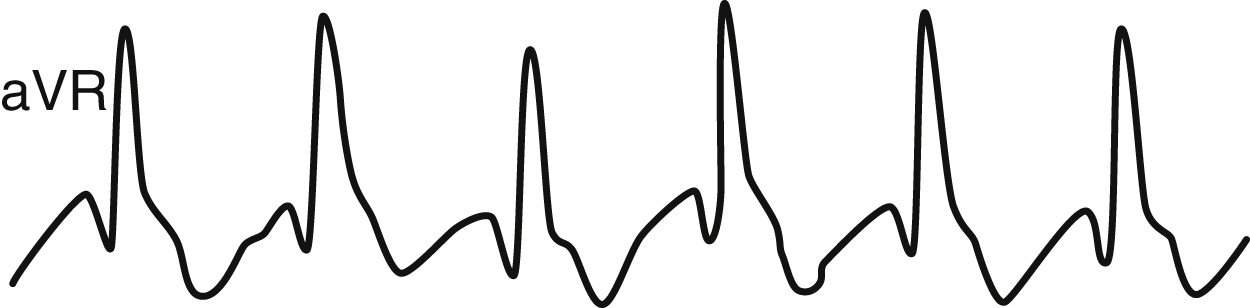 The ECG shows the augmented vector right lead labeled aVR. The waveform shows a prominent tall R wave consistently present in each heartbeat cycle, shows an abnormal electrical pattern.